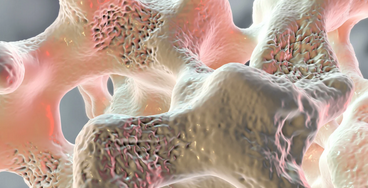 أسباب الإصابة بهشاشة العظام 